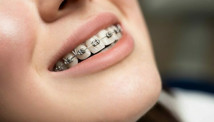 Braces Treatment