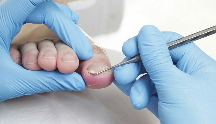 Ingrown Toenail